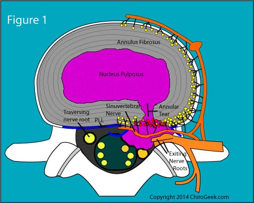 Can You Self-Diagnose Disc Protrusion Based On Symptoms Alone?