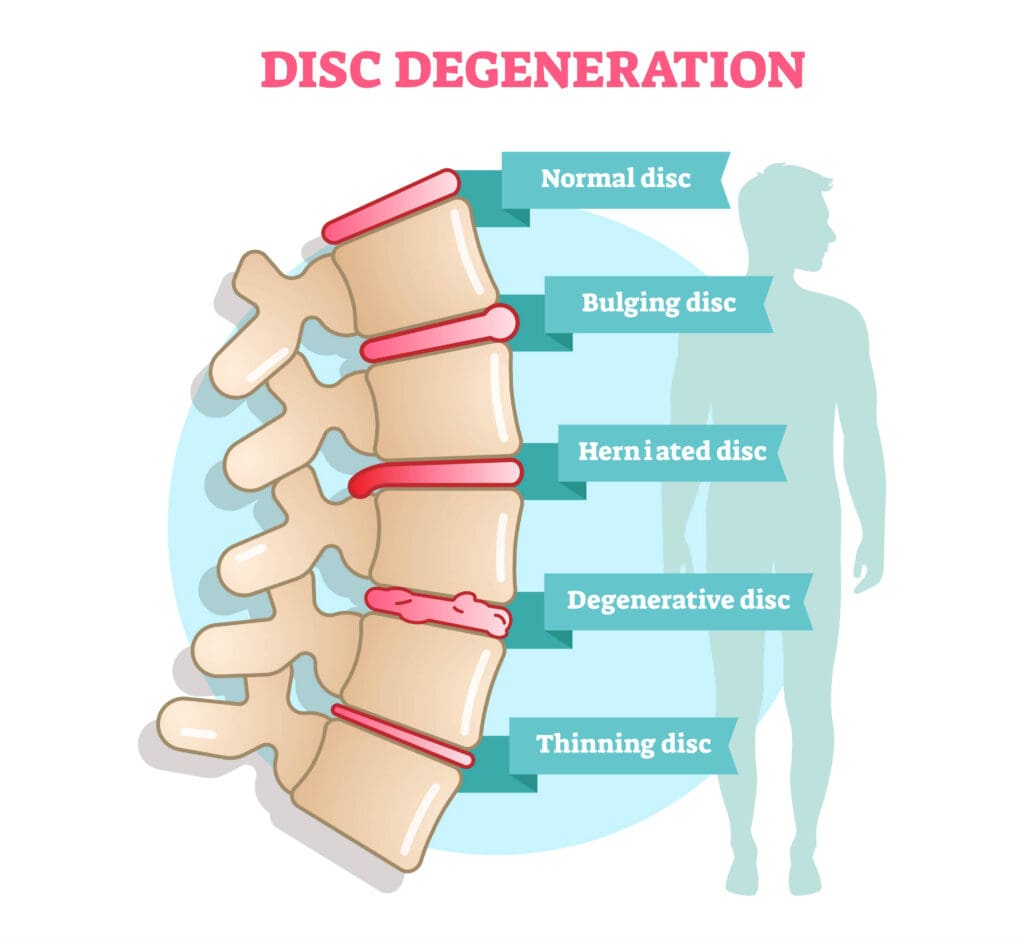 Can You Self-Diagnose Disc Protrusion Based On Symptoms Alone?