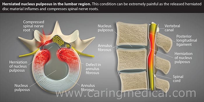 Can You Self-Diagnose Disc Protrusion Based On Symptoms Alone?