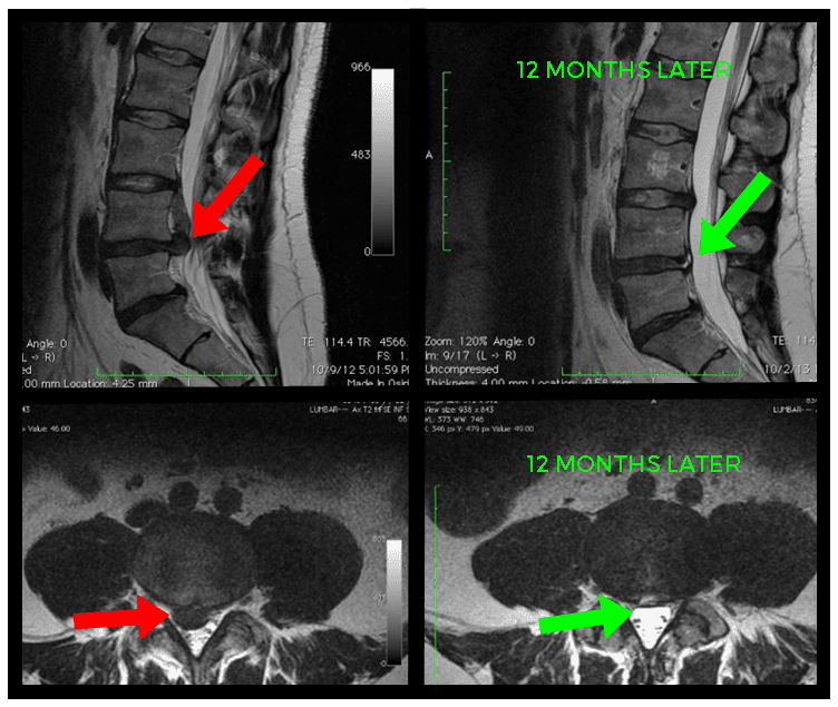 Can You Self-Diagnose Disc Protrusion Based On Symptoms Alone?