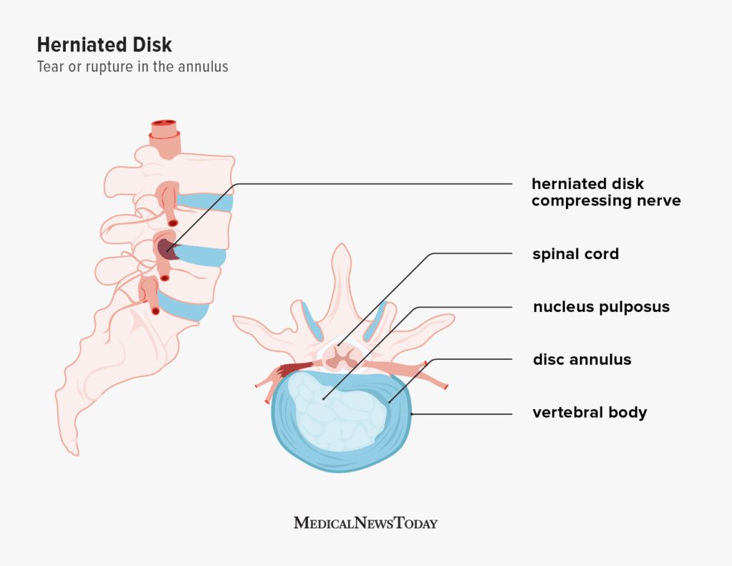 Complications Of Disc Protrusion
