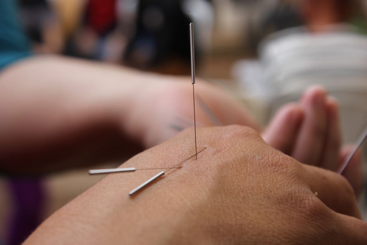 Key Benefits Of Acupuncture For Disc Protrusion Treatment