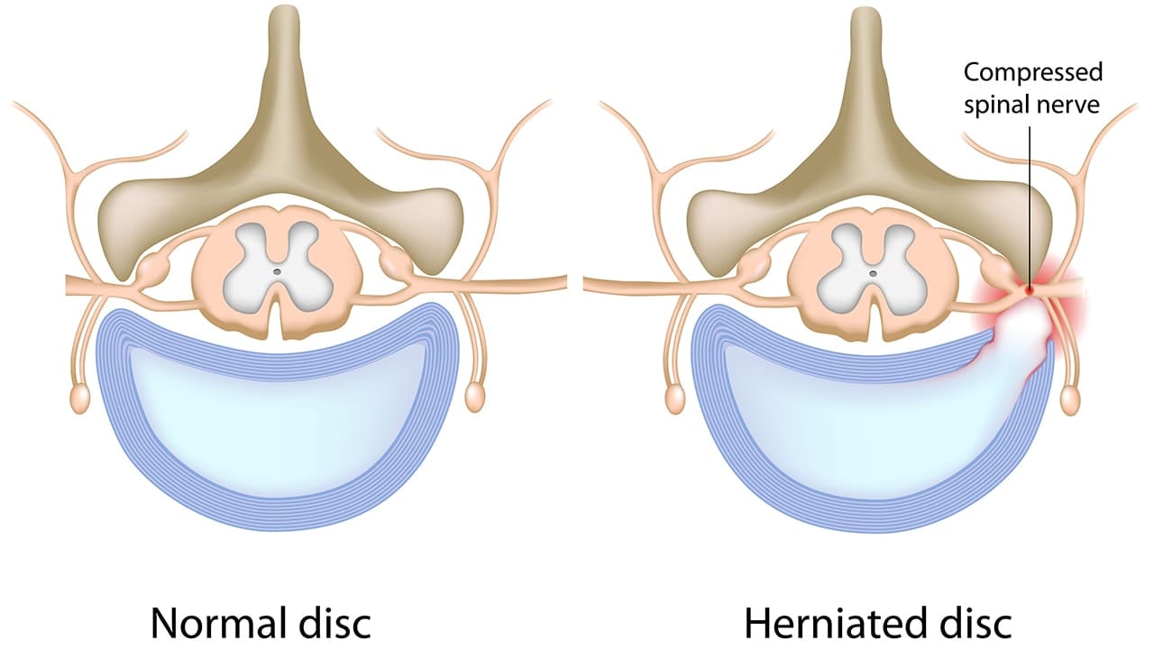 How To Advocate For Yourself During The Diagnosis Of Disc Protrusion