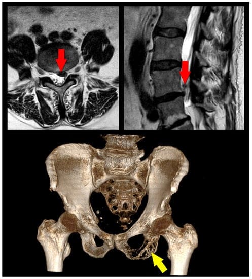 The Prevalence Of Misdiagnoses For Disc Protrusion In Modern Healthcare The Prevalence Of Misdiagnoses For Disc Protrusion In Modern Healthcare
