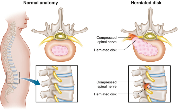 The Prevalence Of Misdiagnoses For Disc Protrusion In Modern Healthcare The Prevalence Of Misdiagnoses For Disc Protrusion In Modern Healthcare