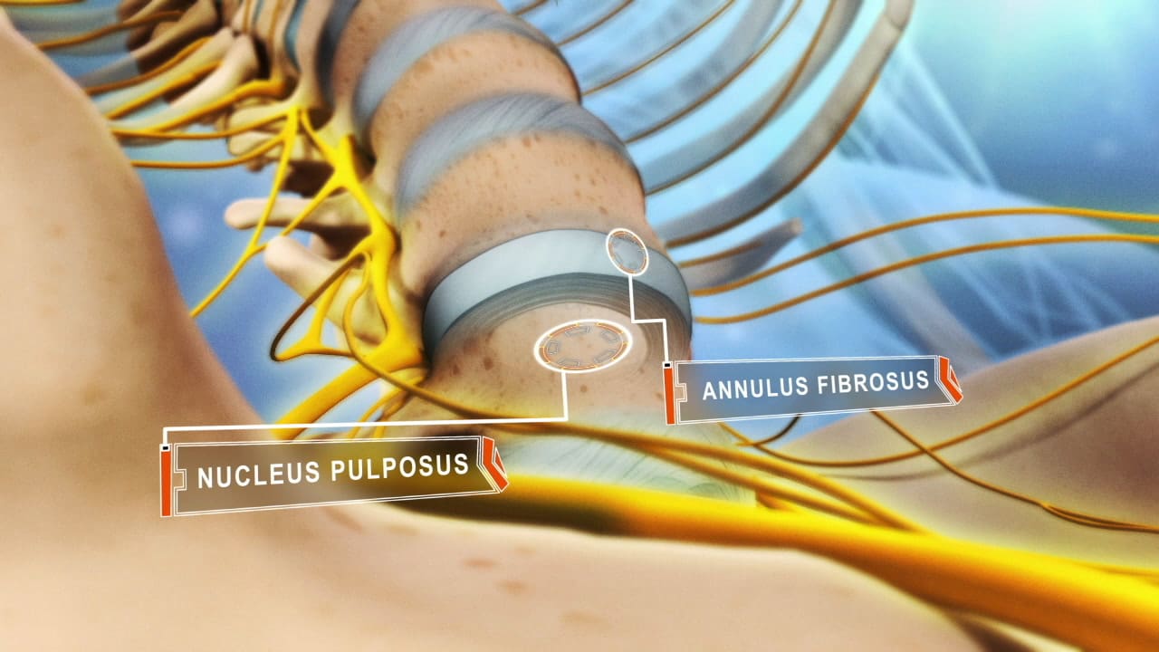 Best Ways To Build A Support Network For Disc Protrusion Recovery