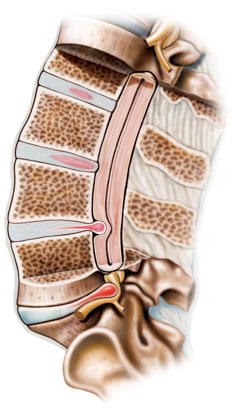 Promising New Advances In Disc Protrusion Treatment