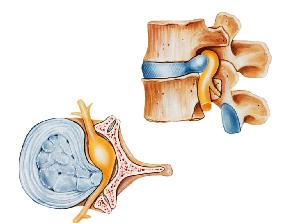 Promising New Advances In Disc Protrusion Treatment