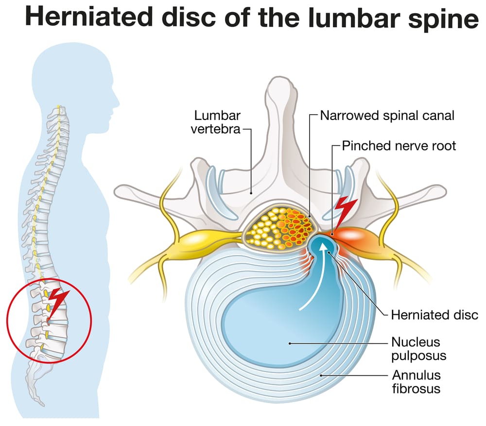 How To Prevent Disc Protrusion From Worsening