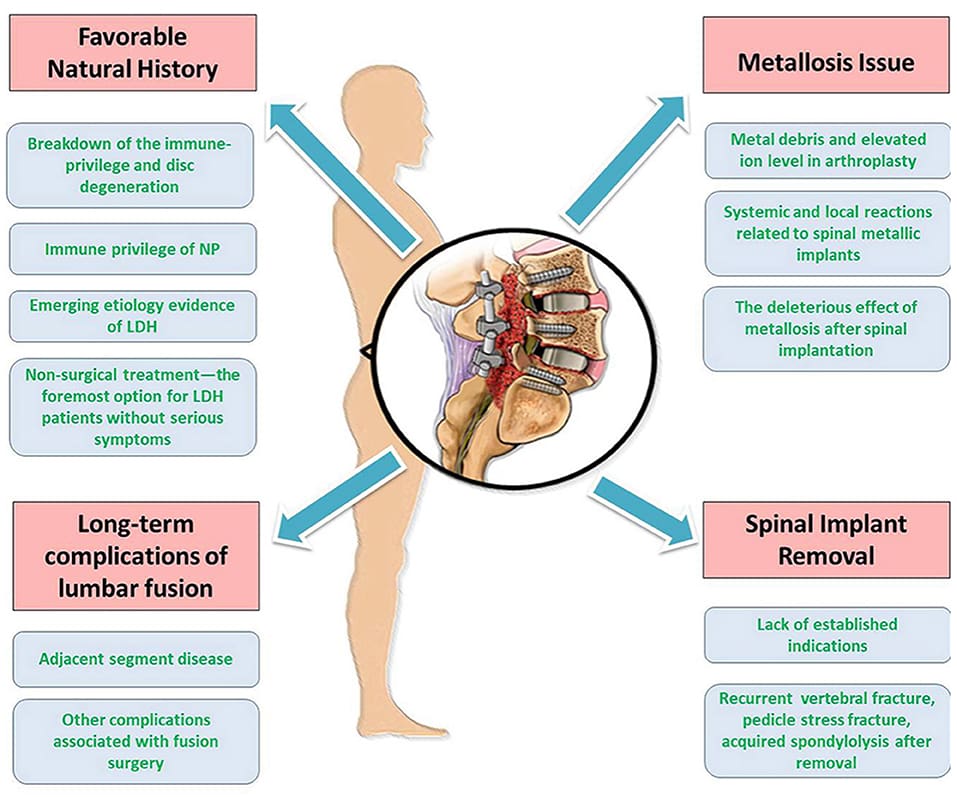 Important Guidelines For Preventing Disc Protrusion In Children