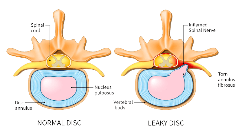 The Importance Of A Multidisciplinary Approach To Disc Protrusion Treatment