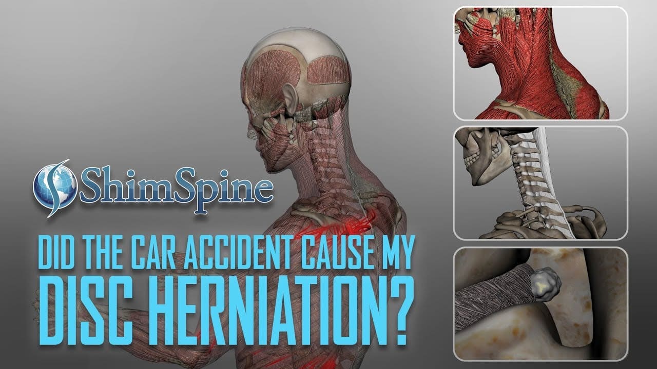 Can Trauma Or Accidents Cause Disc Protrusion?