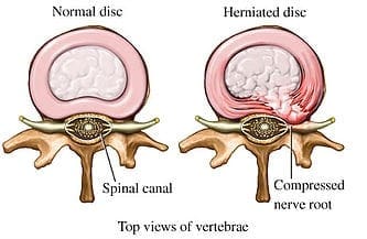 Exploring The Emotional Rollercoaster Of Living With Disc Protrusion Symptoms