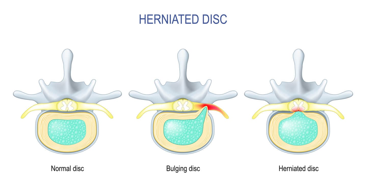 Non-surgical Approaches To Managing Disc Protrusion