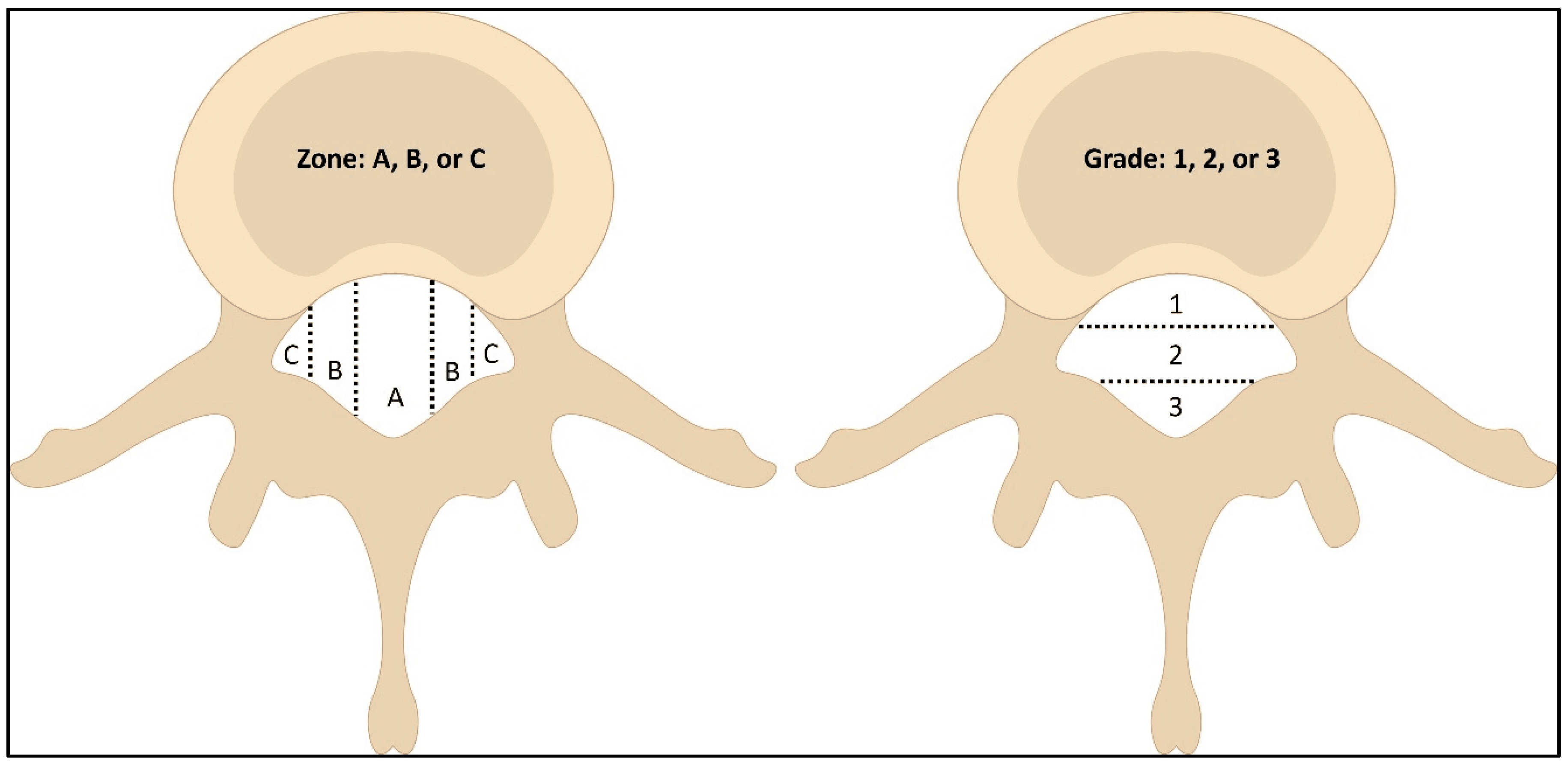 Non-surgical Approaches To Managing Disc Protrusion