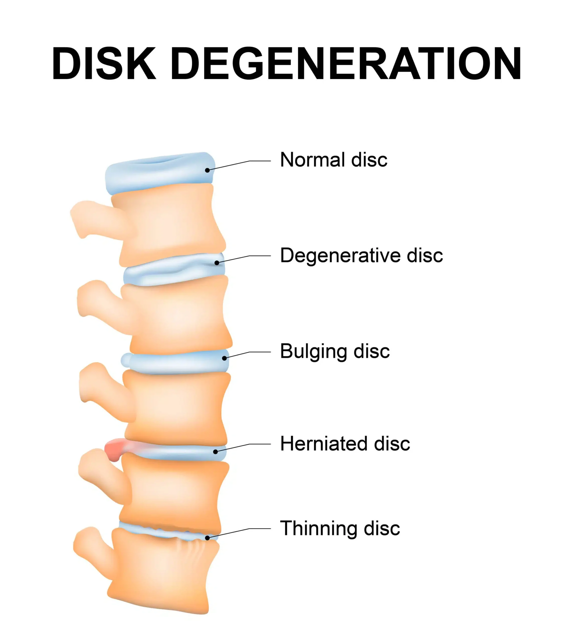 The Psychological Impact Of Living With Disc Protrusion