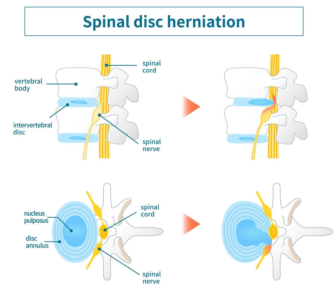 The Role Of Physical Therapy In Disc Protrusion Recovery