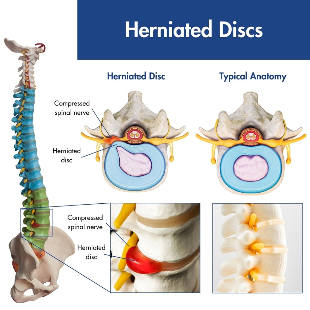 How I Found Relief From Debilitating Disc Protrusion Symptoms