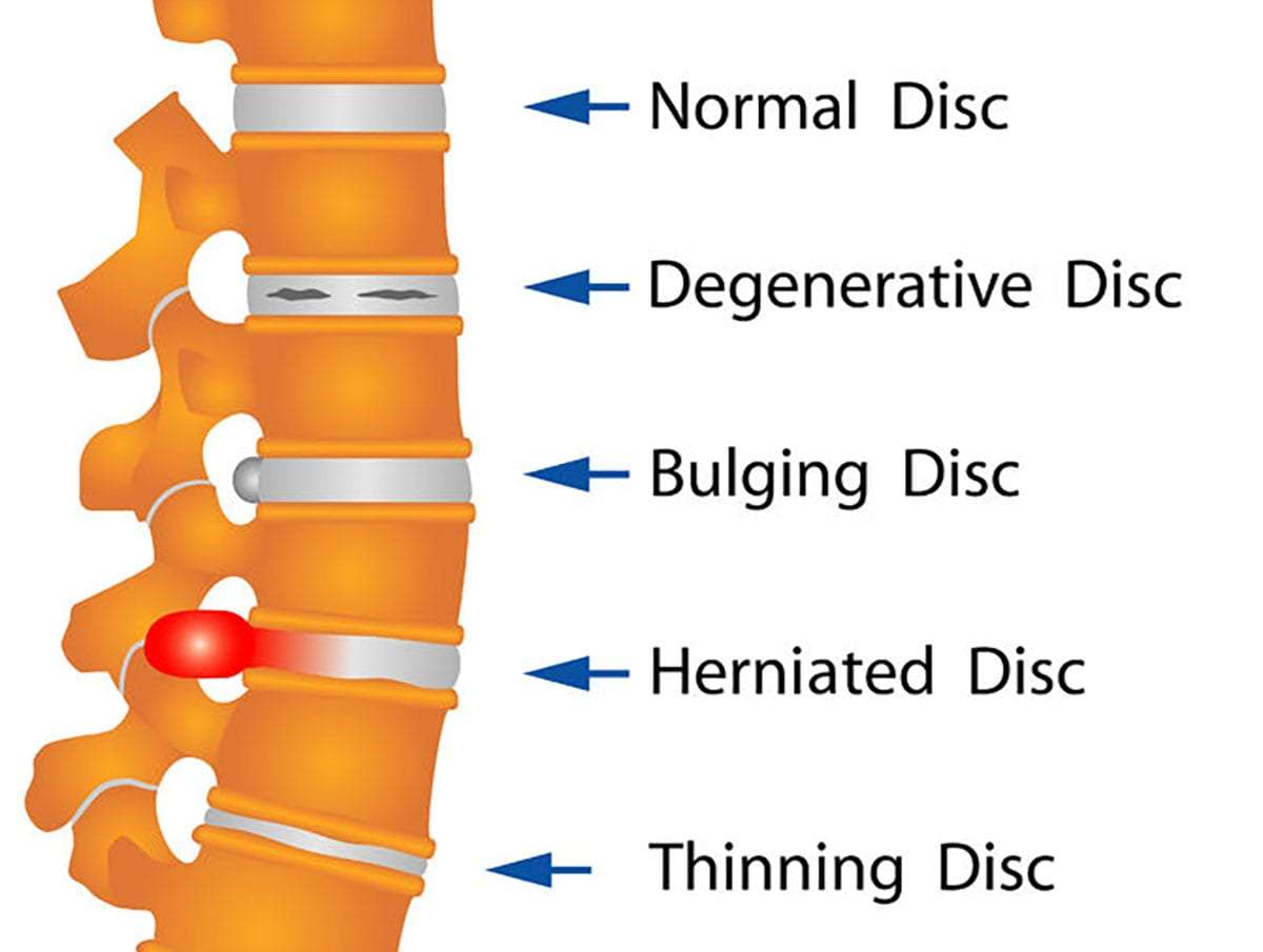 Are Certain Occupations More Prone To Disc Protrusion?